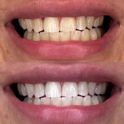 Crest 3D Whitestrips Professional Effects – Teeth Whitening