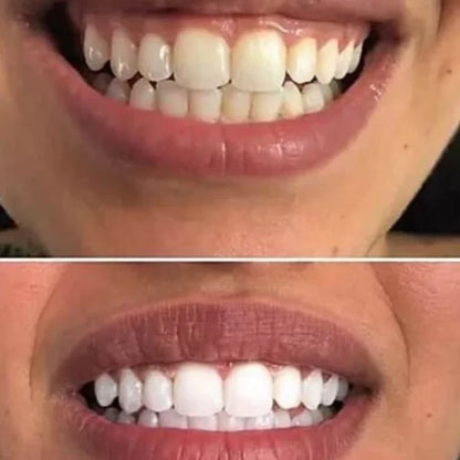 Crest 3D Whitestrips Glamorous Effects – Teeth Whitening